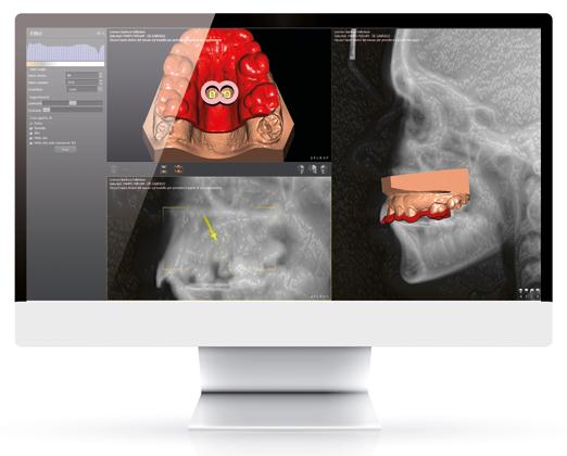 È stata messa a punto la nuova metodica EASY- DRIVER che, grazie all utilizzo di immagini radiologiche e modelli digitali, permette: Un posizionamento preciso delle minviti BENEfit mediante il