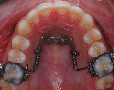 del tempo di inserimento Qualsiasi tipo di apparecchiatura ortodontica può essere adattata e applicata