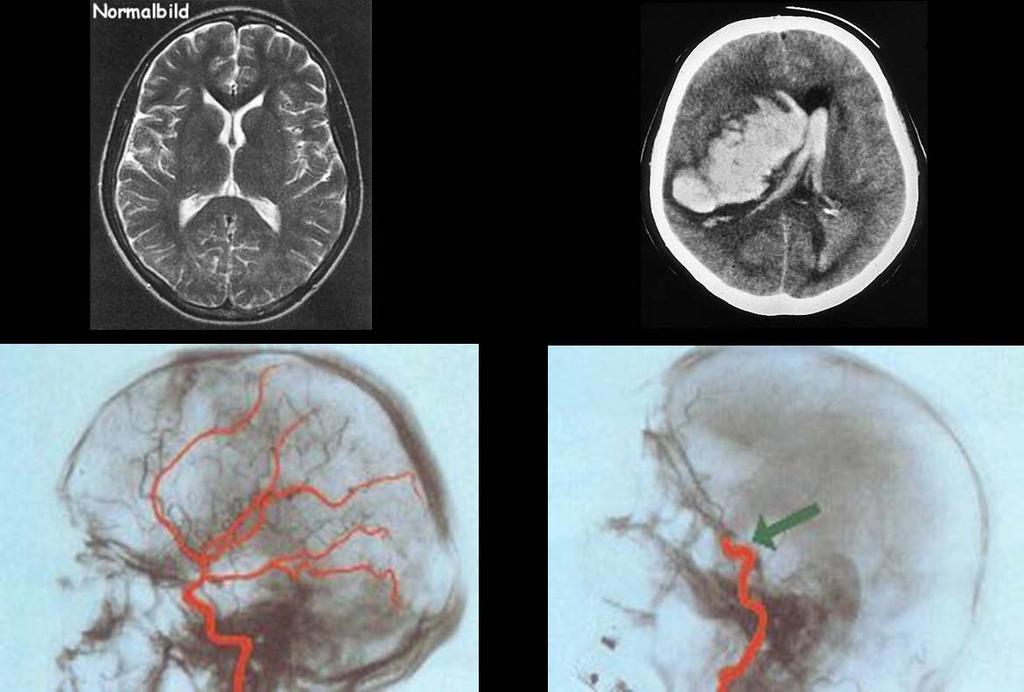 Morte cerebrale diagnostica per immagini Figura 1 Figura MRI