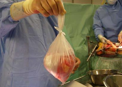 Procedura della donazione d organi Evento Terapia intensiva Morte cerebrale Consenso