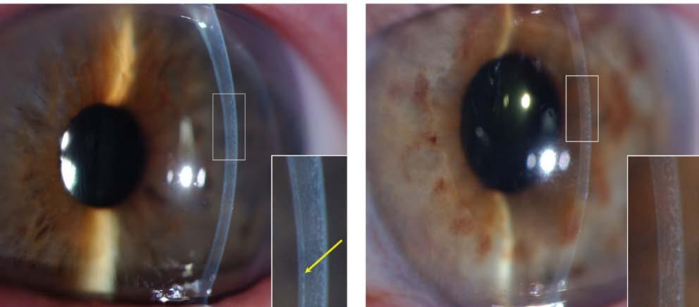 Il trapianto della cornea 772 operazioni all anno in 2015* tipo di