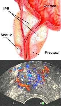 INFERTILITA MASCHILE TRATTAMENTO NON POSSIBILITA TERAPEUTICHE anorchia; aplasia cellulare;