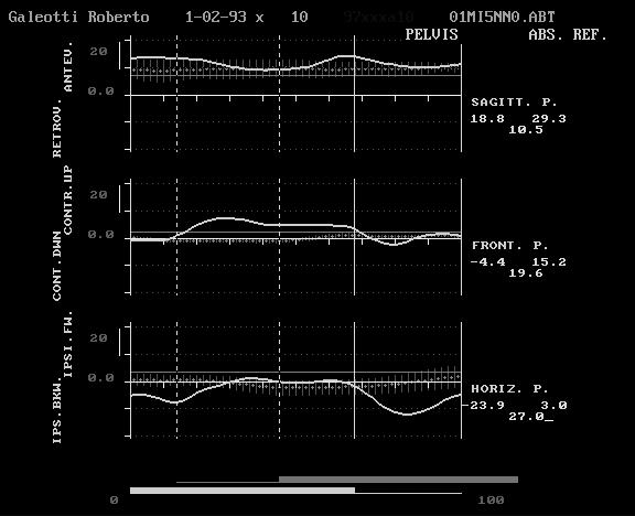 movements to drive legs passive oscillations Obliquity Horiz rot Normative patient Analisi degli effetti funzionali di splint nella distonia