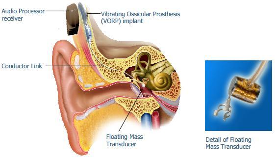 Le protesi a stimolazione diretta dell orecchio medio 1.