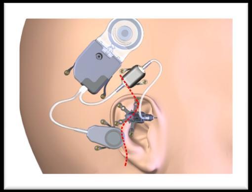 3. IMPIANTO CARINA e MET L impianto Carina è una protesi totalmente impiantabile che rappresenta l evoluzione tecnologica dell Otologics MET (Middle Ear Transducer) [60,64], protesi semimpiantabile