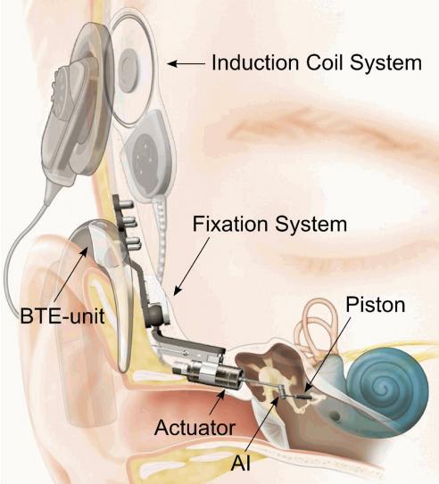 Le protesi a stimolazione diretta cocleare Impianto DACS L impianto DACS (Direct Acoustic Cochlear Stimulator), sviluppato dalla Phonak Acoustic Implants SA, e attualmente commercializzato dalla