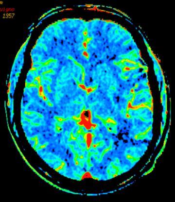 con: MTT CBF CBV ora di insorgenza dell' ictus non nota o ictus presente al risveglio, qualora le neuroimmagini avanzate