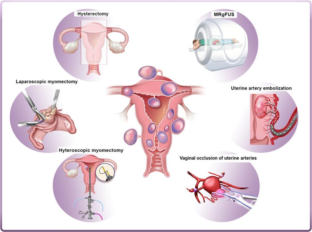 Therapy for the management of fibroids: the current armamentarium Hysterectomy, laparoscopic myomectomy