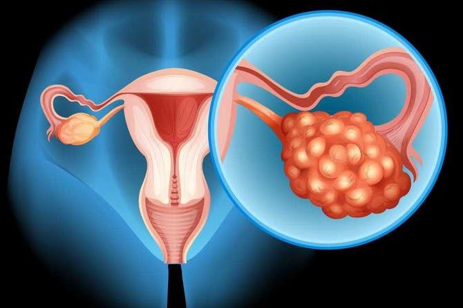 Appropriatezza chirurgica in ginecologia: cisti ovariche Il tasso di incidenza di K ovarico diagnosticato nel corso di una