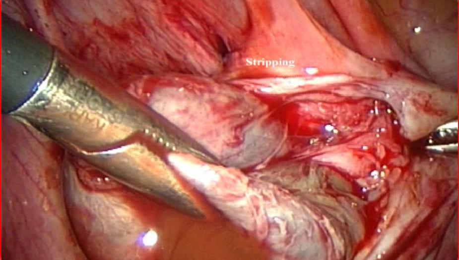Management of endometrioma Surgical technique Excisional technique (stripping) Perform cystectomy in OMA instead of