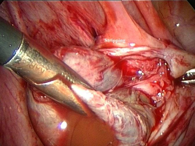 ovarian tissue Sanchez et al, Hum Reprod Update 2014 Muzii L, Hum Reprod, 2014 Previous surgery for