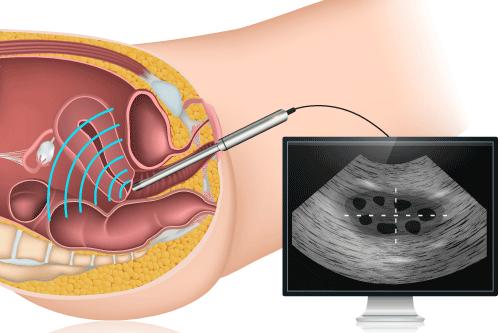 Management of endometrioma: ovarian reserve Anti-mullerian