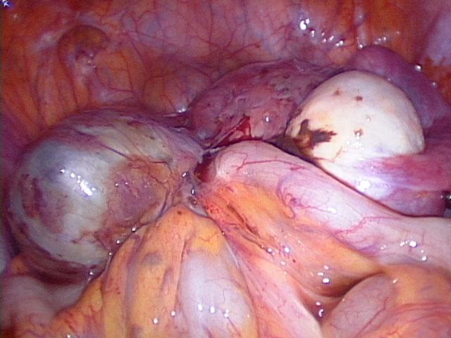 Management of DIE Several findings show the superiority of laparoscopy vs laparotomy in the treatment of pelvic endometriosis, provided that the surgical procedure is performed