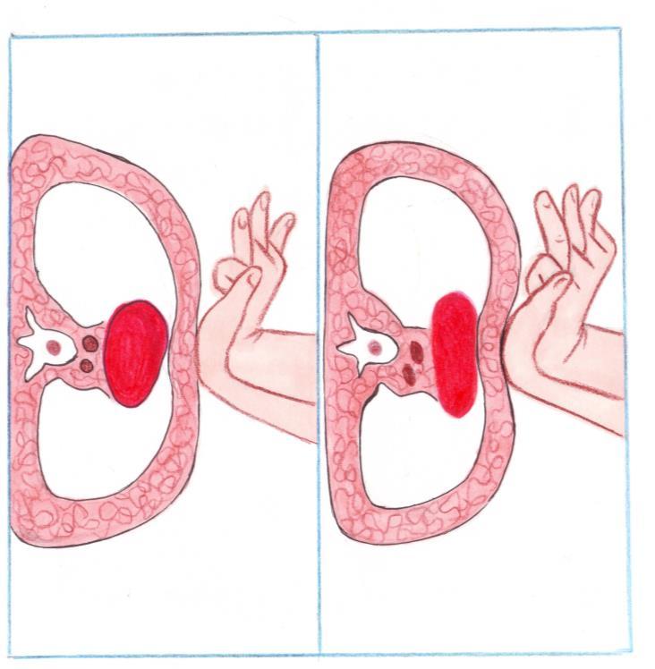 MASSAGGIO CARDIACO Durante l esecuzione del massaggio cardiaco vengono applicate, con entrambe le mani, compressioni profonde e