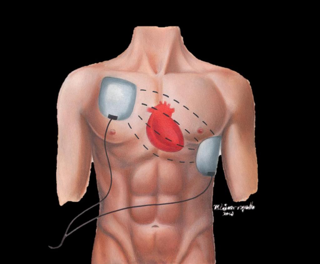 UTILIZZO DEL DAE ANTERO-LATERALE DESTRA: sotto la clavicola destra, a lato dello sterno