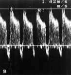 Shunt Growing Shunt dx-sn in sistole