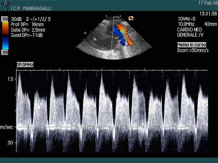 Pulsatile Shunt Sn Dx Caratteristico di un ampio shunt sinistro-destro Alta velocità in sistole e bassa in diastole (< di 1m/sec