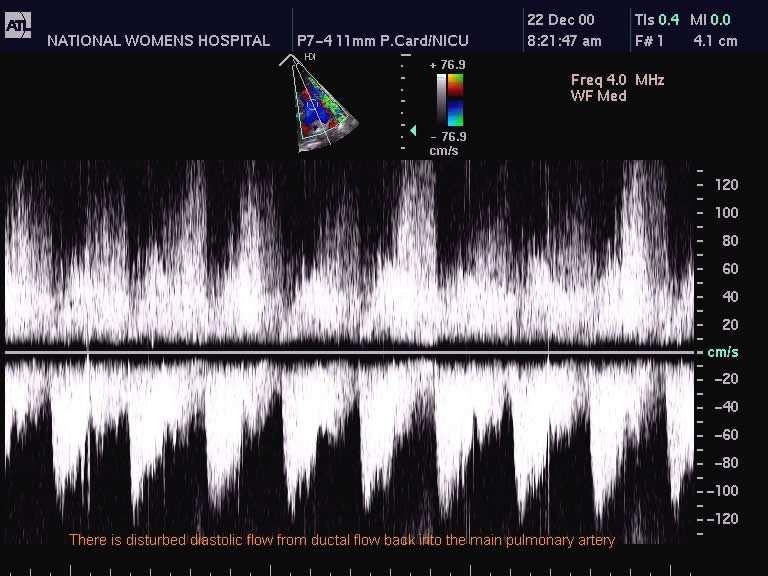 Valutazione ecocardiografica di PDA Flussimetria Apsn velocità di flusso