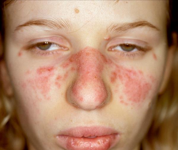 1 2 Dermatite Seborroica LES