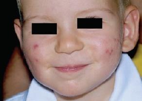 familiare di acne severa nell adolescenza Cunliffe 1/4 Hello 9/16