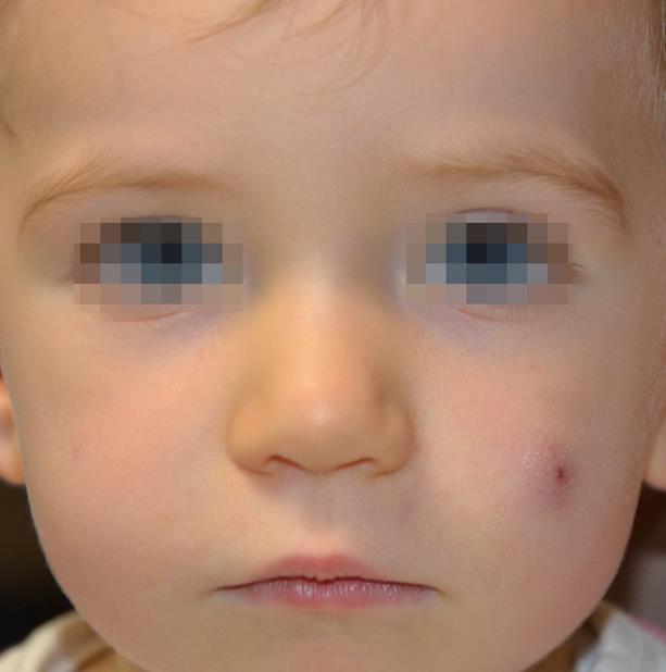 Idiopoathic Facial Aseptic Granuloma (IFAG) Lesione benigna Nodulo rosso-violaceo Consistenza elastica Freddo, asintomatico Regione