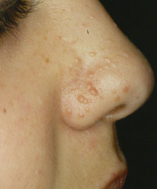 Sclerosi tuberosa Angiofibromi del volto Convulsioni Ritardo mentale Macule leucodermiche Fibromi periungueali