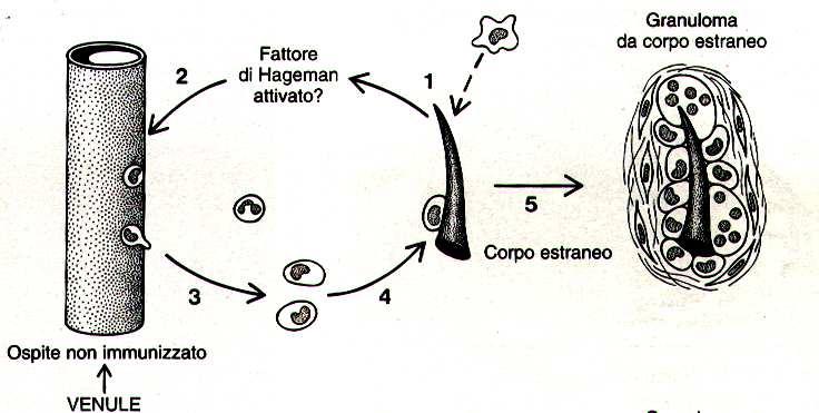 Evoluzione frequente verso la necrosi Guarigione in sclerosi Granulomi da corpo estraneo causati da corpi