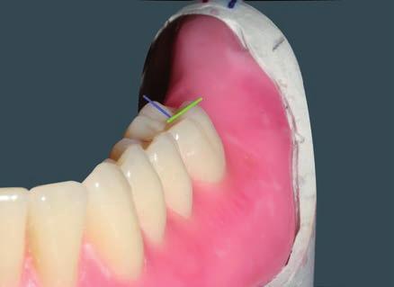 Le inclinazioni delle cuspidi distolinguali e mesiobuccali dei molari vengono orientate inclinandole uniformemente verso la fessura centrale, al fine di ottenere una