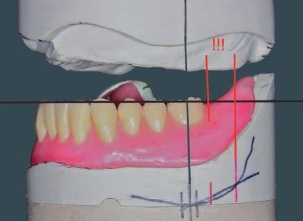 Ciò è importante, per ottenere successivamente un bilanciamento nella zona dei molari (mediotrusione/ laterotrusione). Se non viene eseguito il montaggio del 2. molare, il 1.