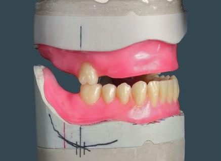 molare viene posizionato, si troverà con la sua faccia distale al di sopra del piano d occlusione e il 1. molare con tutte le cuspidi buccali a livello del piano d occlusione.