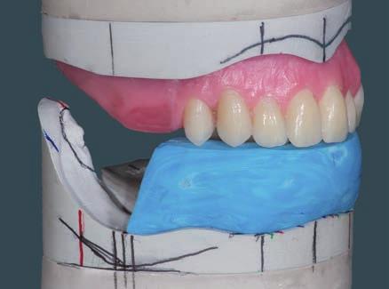 Per trasferire l arco dentale frontale è necessaria un ulteriore mascherina in silicone.