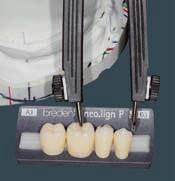La larghezza e il design dei denti frontali può essere scelta in base alla