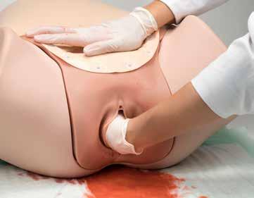 Oltre al sanguinamento centrale dall utero, consente di dimostrare anche il sanguinamento dovuto a lesioni che si