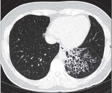 TERAPIA (3) Chirurgia Resezione completa dell area polmonare affetta: - emorragie massive - processi infettivi o emoftoici