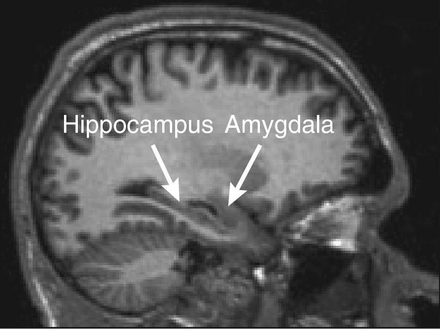 AMIGDALA Iperattività dell amigdala associata sia con stimoli che ricorda il trauma, che con stimoli emotivi non correlati con il trauma.