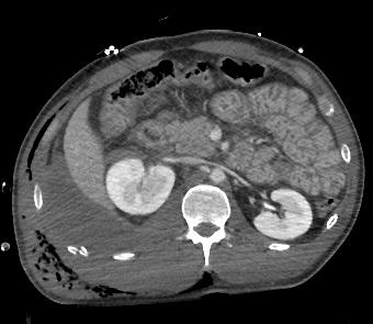 Il trauma epatico: DIAGNOSI TC Emoperitoneo