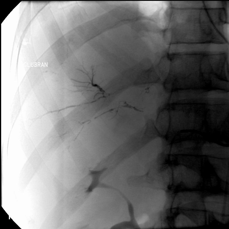 EMBOLIZZAZIONE Per gentile cortesia del servizio di