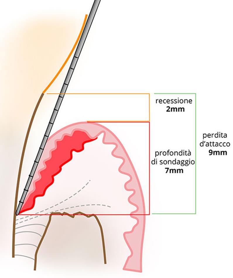 LIVELLO DI ATTACCO CLINICO (CAL) Distanza tra