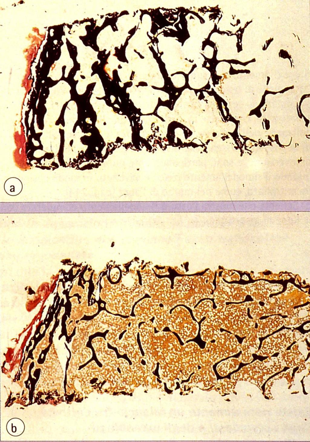 Osteoporosi: a) Fotografia al microscopio ottico di una sezione in resina di una biopsia ossea della cresta iliaca, raffigurante osso corticale e trabecolare normale, colorati con un metodo all