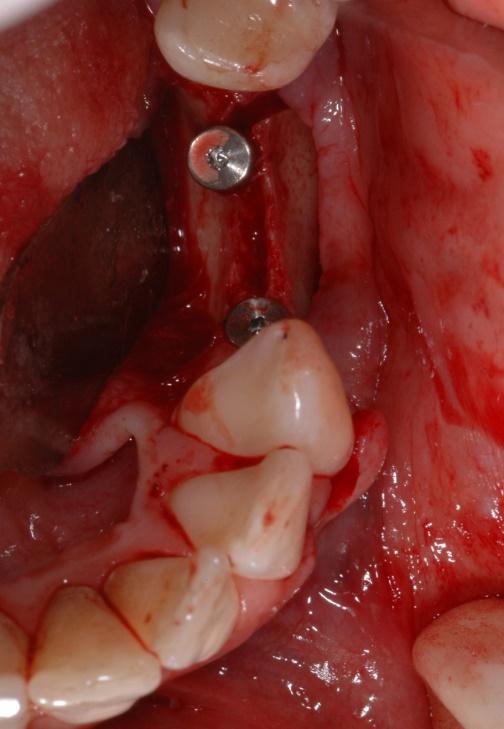 Un blocchetto di osso prelevato da un sito donatore della bocca, vi viene avvitato e dopo 6 mesi avremo la larghezza di osso utile per l inserimento di un impianto. C.