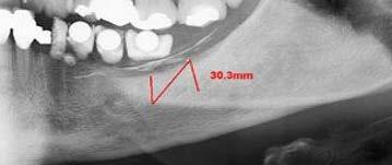 perimplantite ) del vecchio impianto a lama: deve