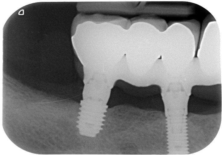 Sinistra: radiografia endorale digitale dell impianto di destra,