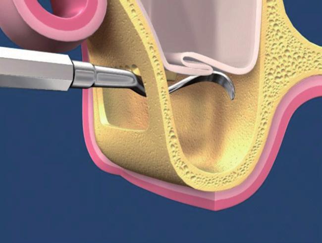 Disegno 4 La finestra ossea è ribaltata nella cavità oppure rimossa. La membrana sinusale è delicatamente sollevata con strumenti appropriati.