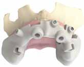 fissaggio della dima standard su denti tramite l impiego di una resina.