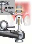 platform shifting, procedure cliniche Connessione dell abutment 6. Healing Abutment PS. 7. Eliminare la vite per abutment fornita insieme al Procera Abutment Zirconia Bmk Syst.