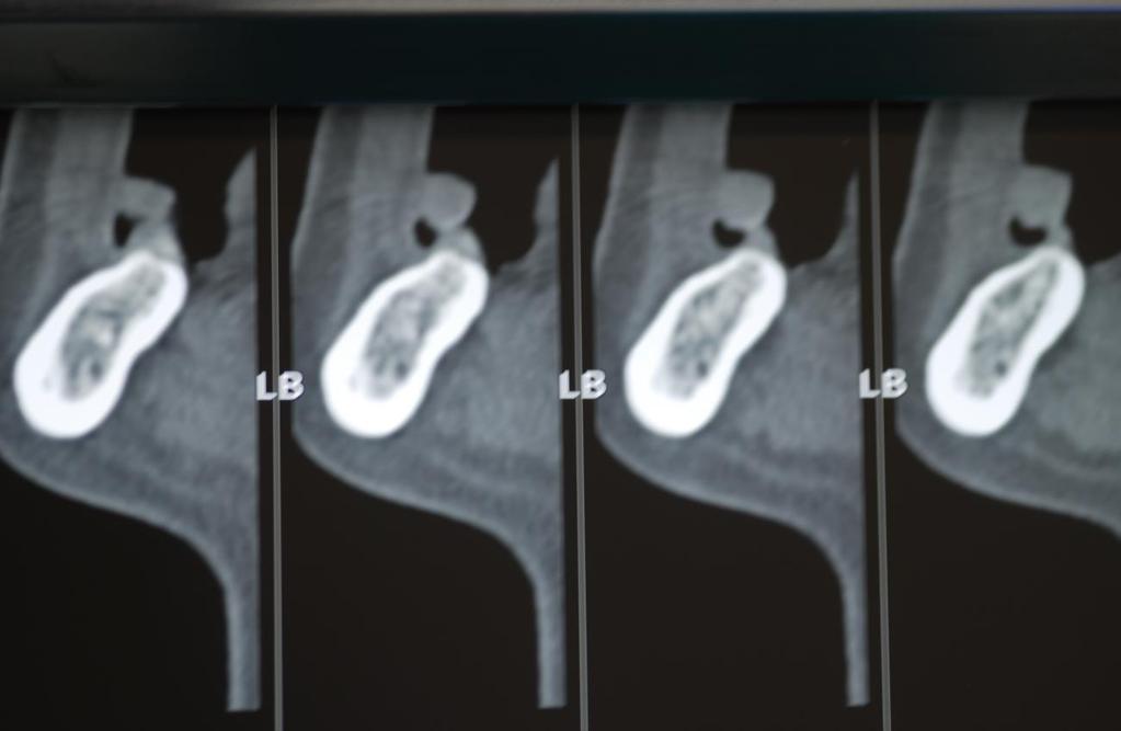 Caso 4 N.C. 42nne di sesso femminile con edentulia dell emiarcata inferiore dx e scarsi spessori ossei operata nel maggio 2011 per l applicazione di due impianti A.