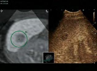 Real-time Virtual Sonography (RVS) RVS unisce l'imaging a ultrasuoni in tempo reale con le immagini