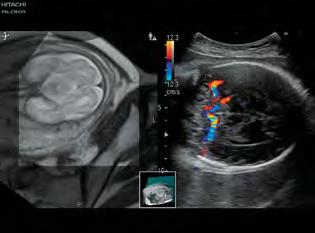 Cuore del feto con AutoFHR Addome del feto con Dual Gate Doppler Cuore del feto con STIC AutoFHR La frequenza cardiaca del feto è calcolata automaticamente da una