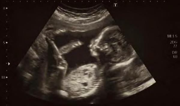 Tumori e gravidanza: assistenza prenatale Gravidanze ad A RISCHIO controlli mensili (almeno) in centri di riferimento Ecografia fetale: accrescimento, morfologia, LA, flussimetria Doppler dei vasi
