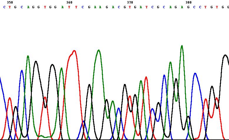 Variazioni di sequenza di Caveolina-3 identificate in pazienti con iperckemia persistente: PAZIENTE